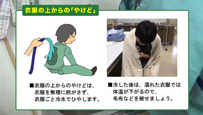 やけど　イメージ2